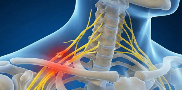 Shoulder nerve injury from arms extended beyond 90 degrees